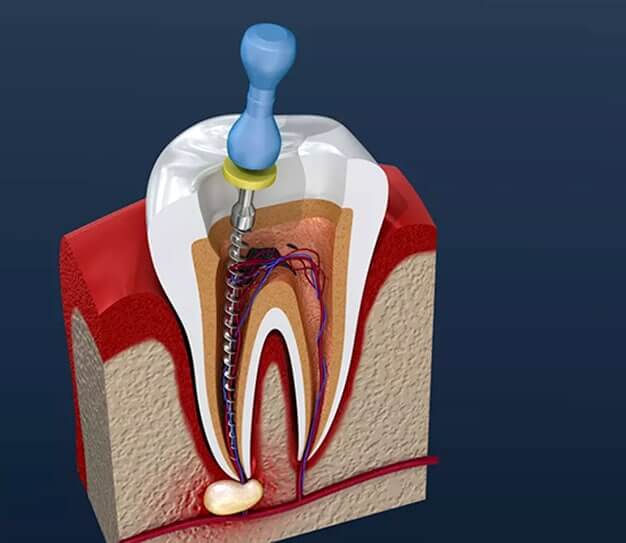 root canal therapy in cypress at smile avenue family dentistry of cypress