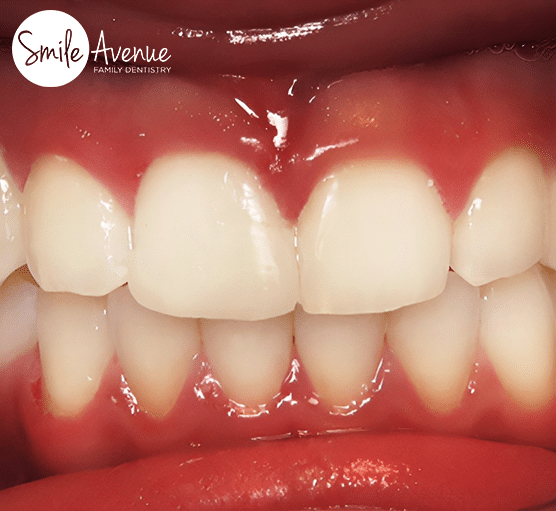 teeth after invisalign treatment at smile avenue family dentistry of cypress