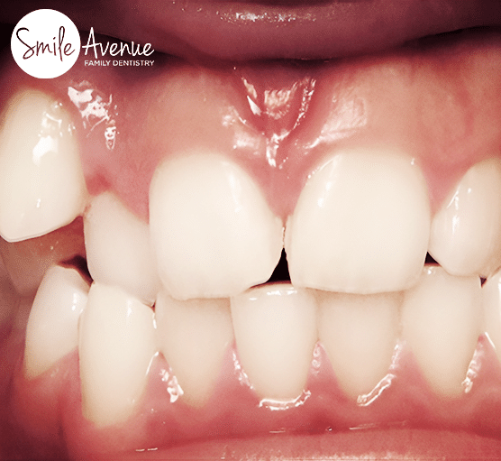 teeth before invisalign treatment at smile avenue family dentistry of cypress