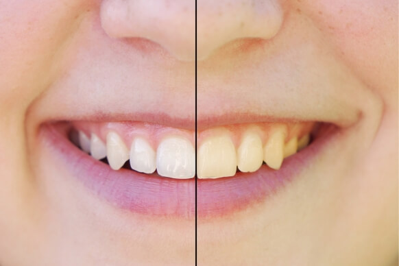 orthodontics in katy at smile avenue family dentistry of katy
