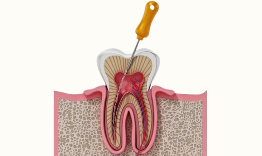 clear up tooth infection without a root canal